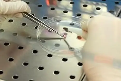 Al via il progetto Mesems per la cura della Sclerosi multipla