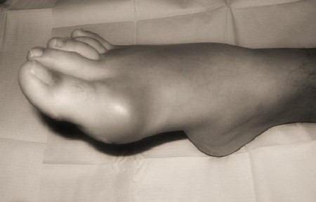 Gotta in aumento. Imparare conoscerla per prevenirla.