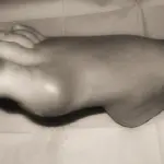 Gotta in aumento. Imparare conoscerla per prevenirla.