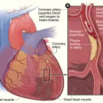 Cerotto d'oro: trovata la cura per l'infarto al cuore