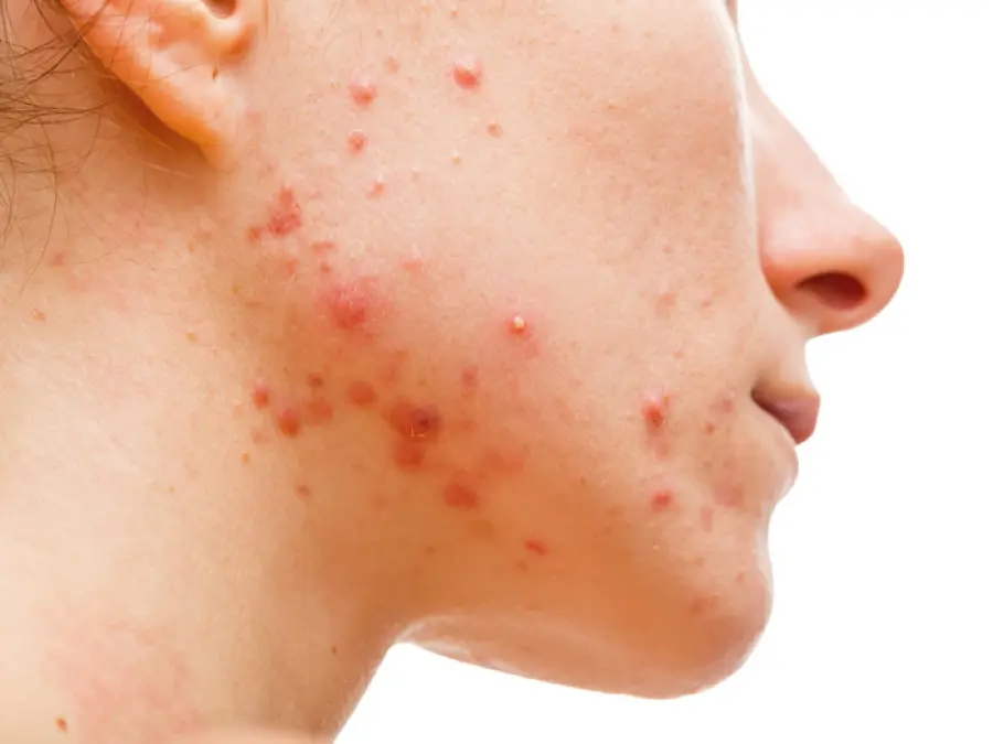 Rimedi Naturali per l'Acne? Secondo il dottor Monti Non Servono