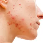 Rimedi Naturali per l'Acne? Secondo il dottor Monti Non Servono