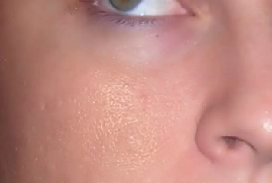 Maschera contro i pori dilatati naturale