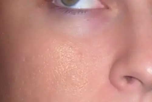 Maschera contro i pori dilatati naturale