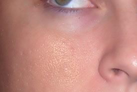 Maschera contro i pori dilatati naturale