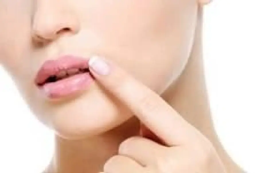 Come combattere l’Herpes labiale con rimedi naturali
