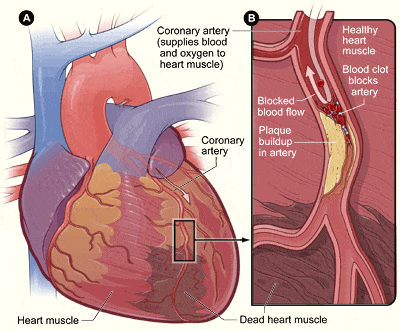 il dettaglio medico di un cuore colpito da infarto nella forma più comune